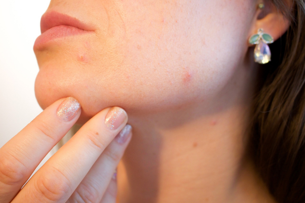 How dermatologist take care of acne and acne scars